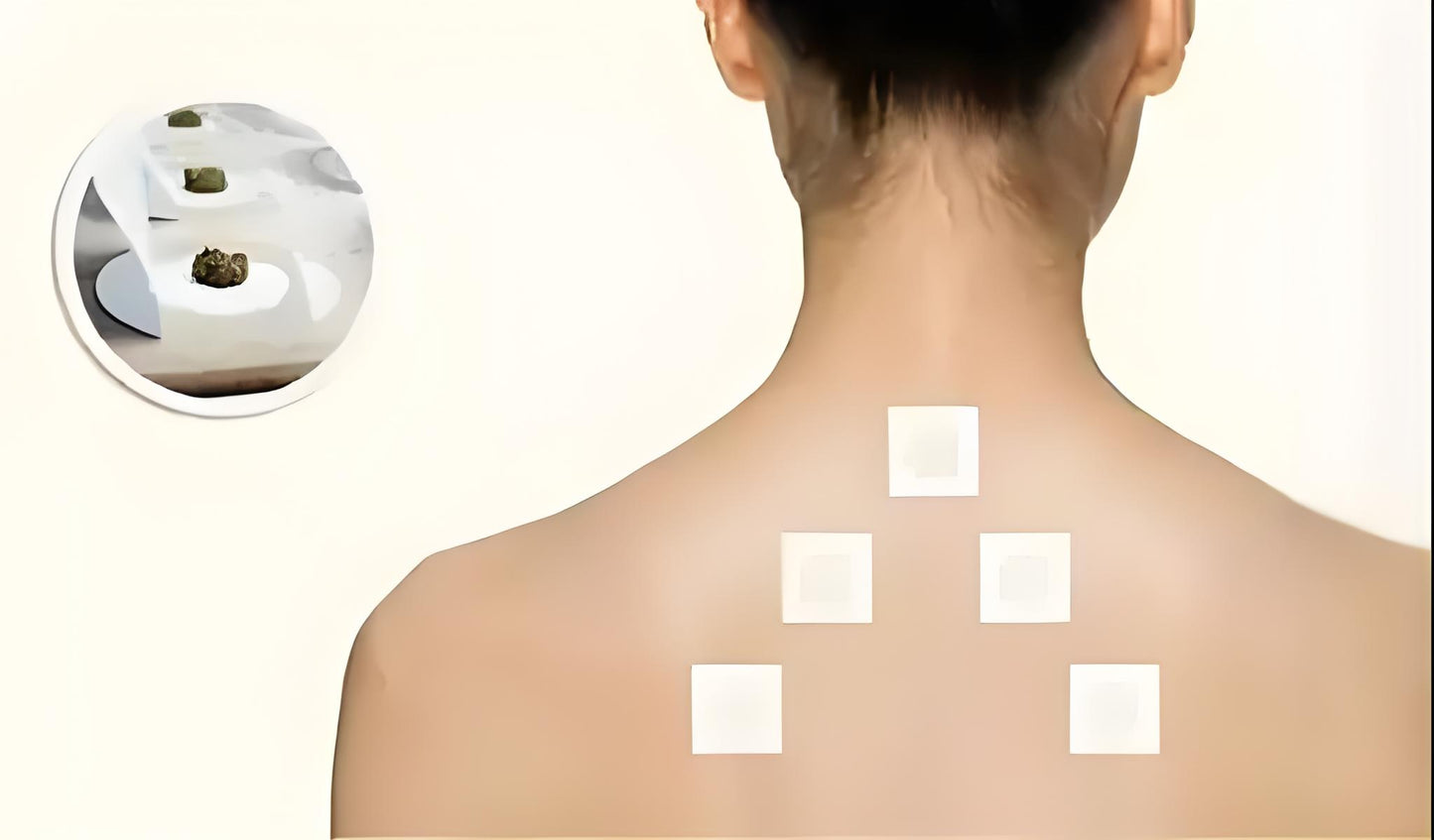 Tianmoxibustion therapy